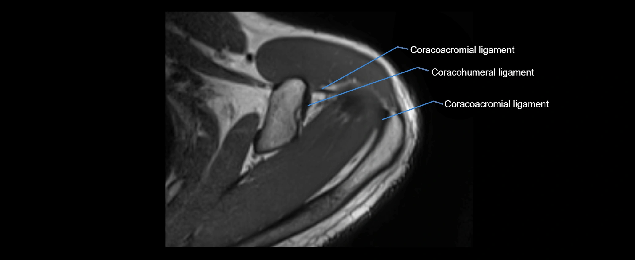 shoulder ligaments axial 3d 3t mri image-img-00005-00037.webp
